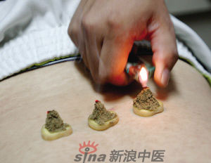 灸法的種類  你知道多少？